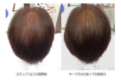 フェルモ:増毛3ステップ:260束ステップ2