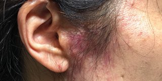 ジアミンによるアレルギー反応例